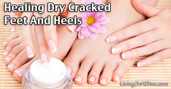 Healing Dry Feet And Cracked Heels
